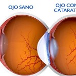 Las células madre han permitido la regeneración del tejido ocular en niños con cataratas.