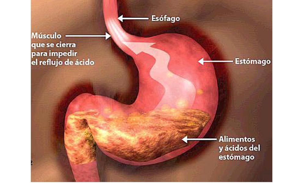 Alimentos malos para el esófago