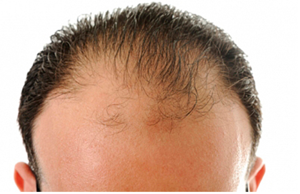 La mitad de los hombres pierden cabello por estrés y hormonas | El Periódico USA | En español Rio Grande Valley, Texas.