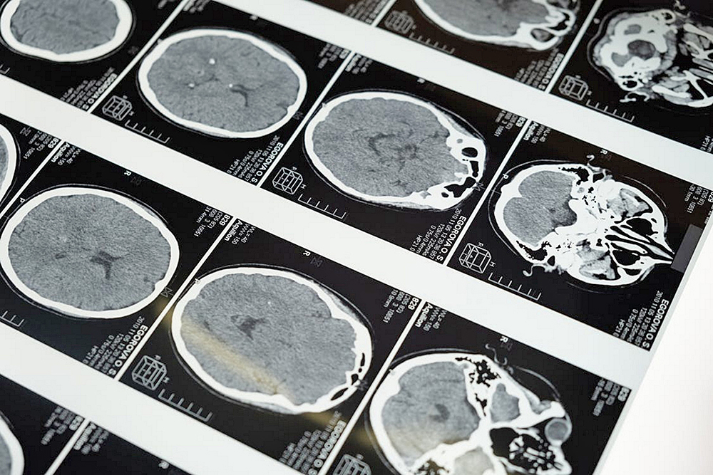 Un estudio gallego analizará la influencia del radón en el desarrollo de  tumores cerebrales