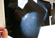 Expertos alertan sobre la falta de registros de cáncer de mamá en América Latina